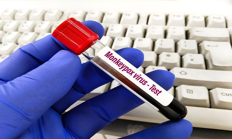 Monkeypox Alert : लखनऊ के अस्पतालों में मंकी पॉक्स को लेकर अलर्ट