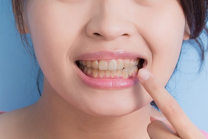 Yellow Teeth Remedies: जानें दांत क्यों हो जाते हैं पीले, ऐसे करें उपाय !