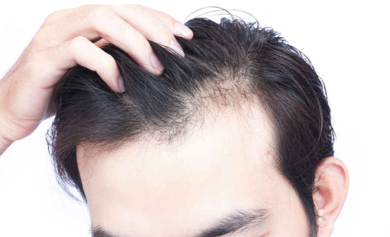 Hair Loss Solution: अगर आपके भी बाल धीरे-धीरे छोड़ रहे है आपका साथ तो आजमाएं ये नुस्खे