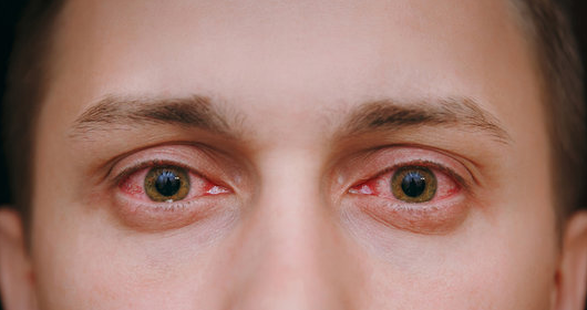 क्या आंखों के लिए खतरनाक है Eye Flu, जानें पूरी बात